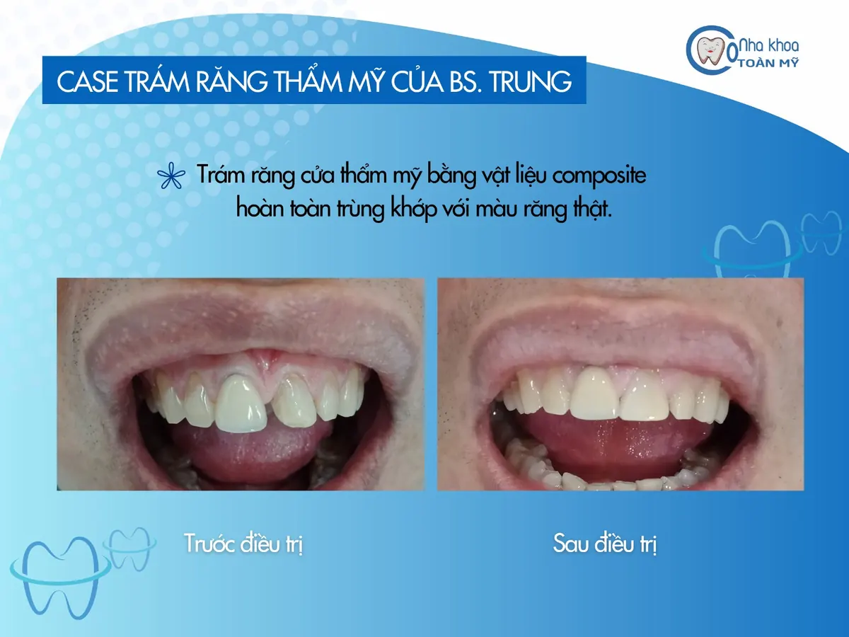 Ca trám răng cửa thẩm mỹ composite trước và sau điều trị tại Nha khoa Toàn Mỹ