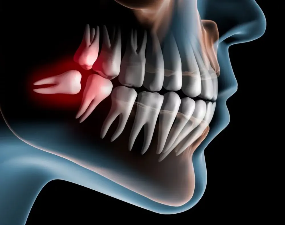 Mô phỏng răng khôn mọc lệch nằm ngang đâm vào răng số bảy gây đau nhức