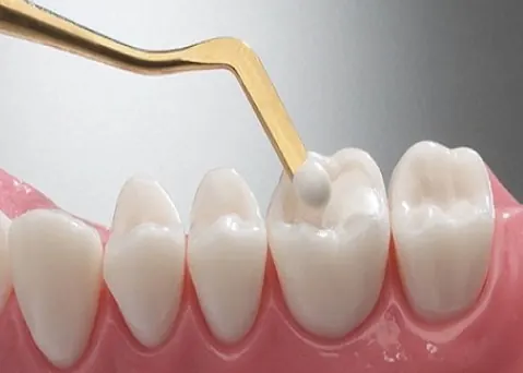 Dụng cụ nha khoa đưa chất trám composite màu trắng vào mặt nhai răng hàm